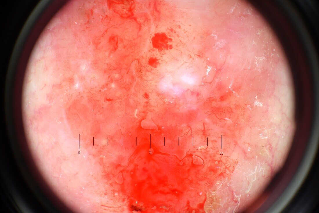 Nodular basal cell carcinoma, deramscope image