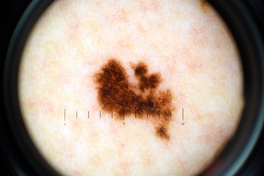 Malignant melanoma, dermascope image
