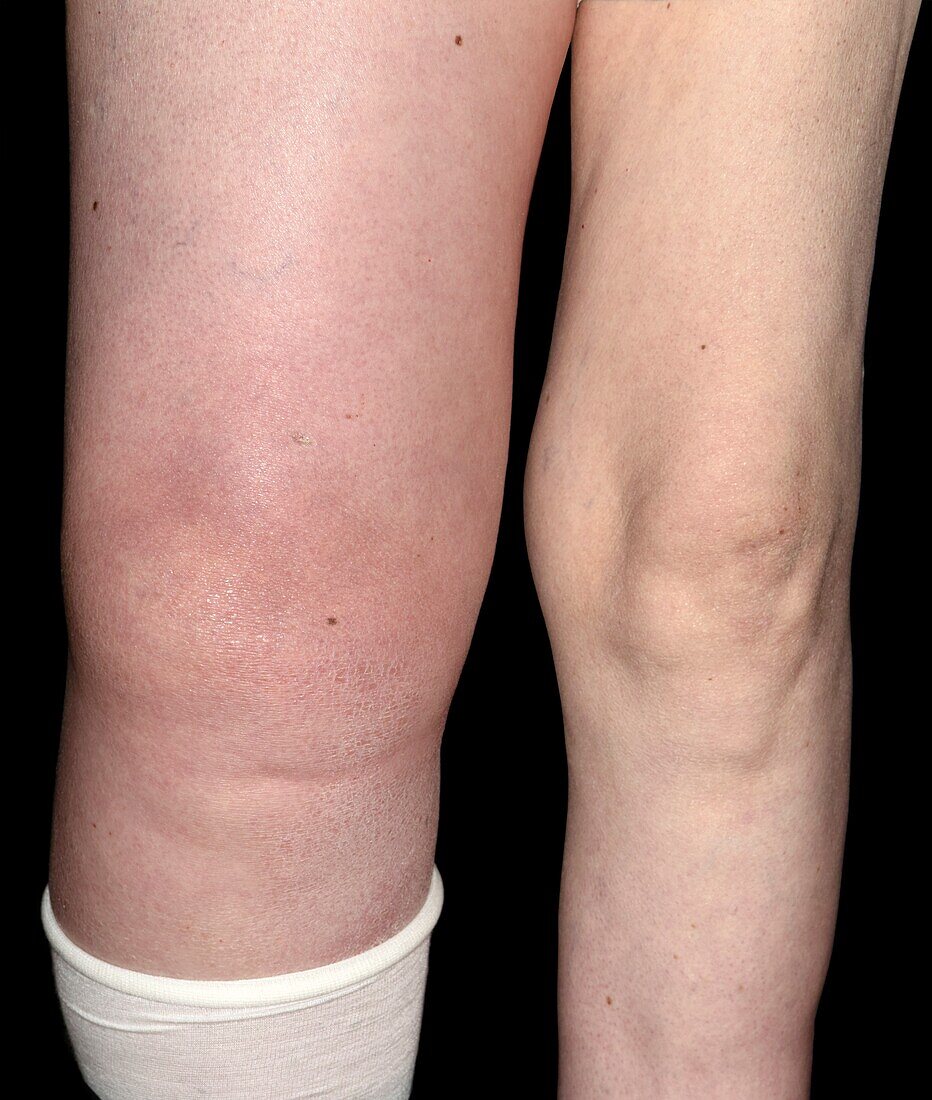 Swelling of leg due to pelvic mass
