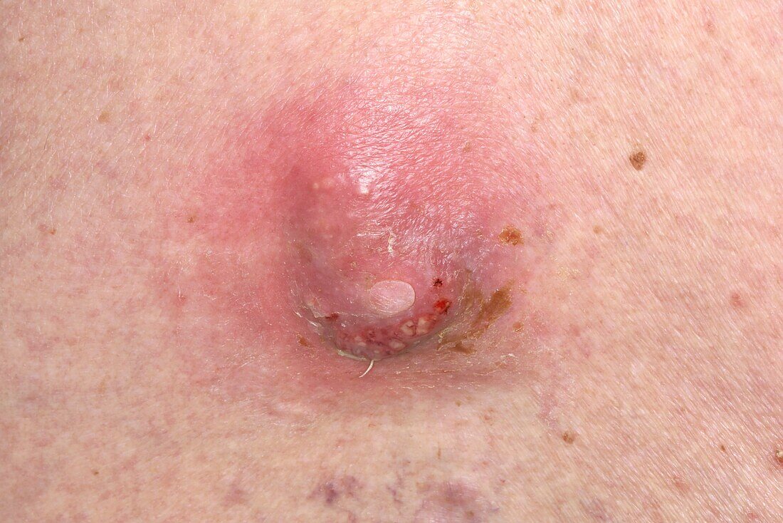 Infected sebaceous cyst