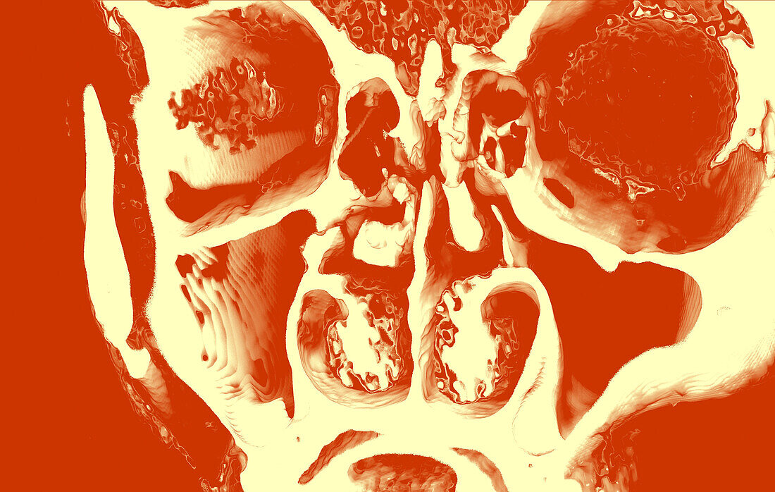 Human skull, CT scan