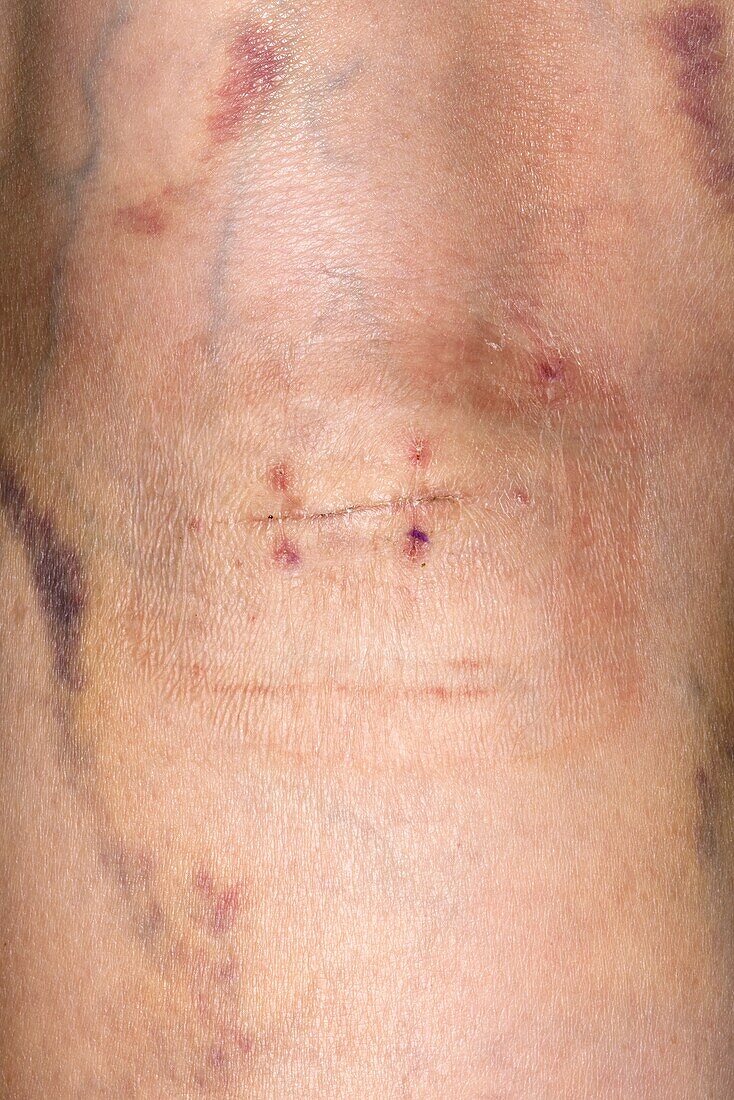 Wound on the back of upper calf