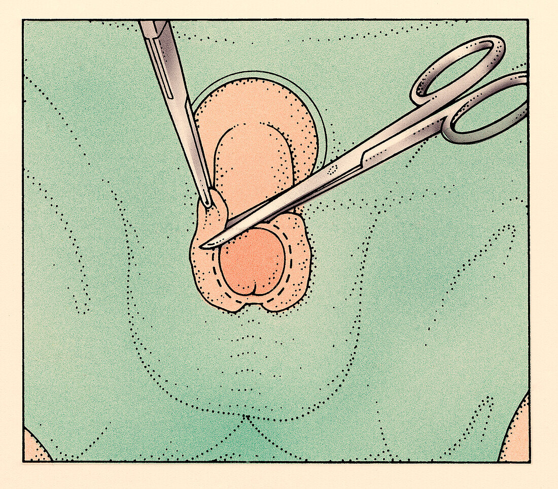 Circumcision, illustration