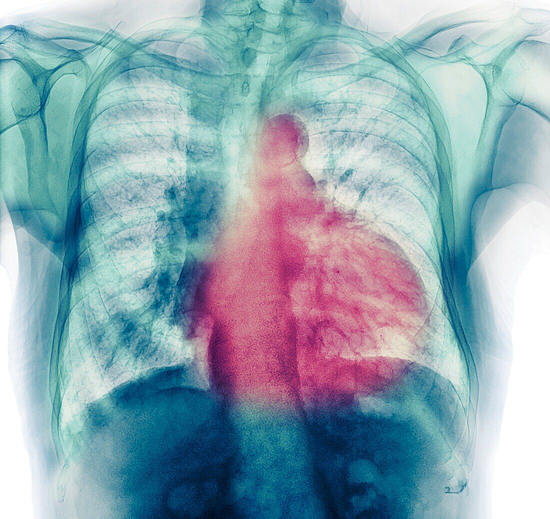 Cardiomyopathy, chest X-ray