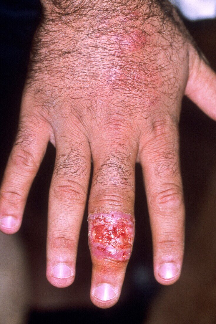 Leishmaniasis lesion