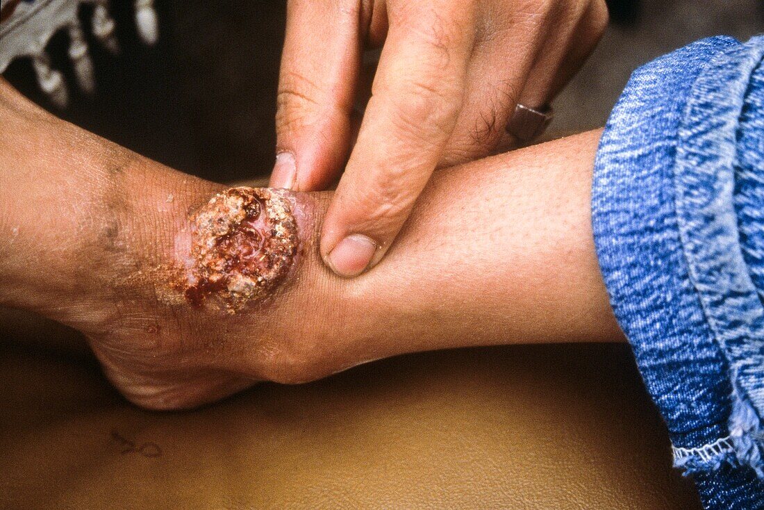 Leishmaniasis lesion