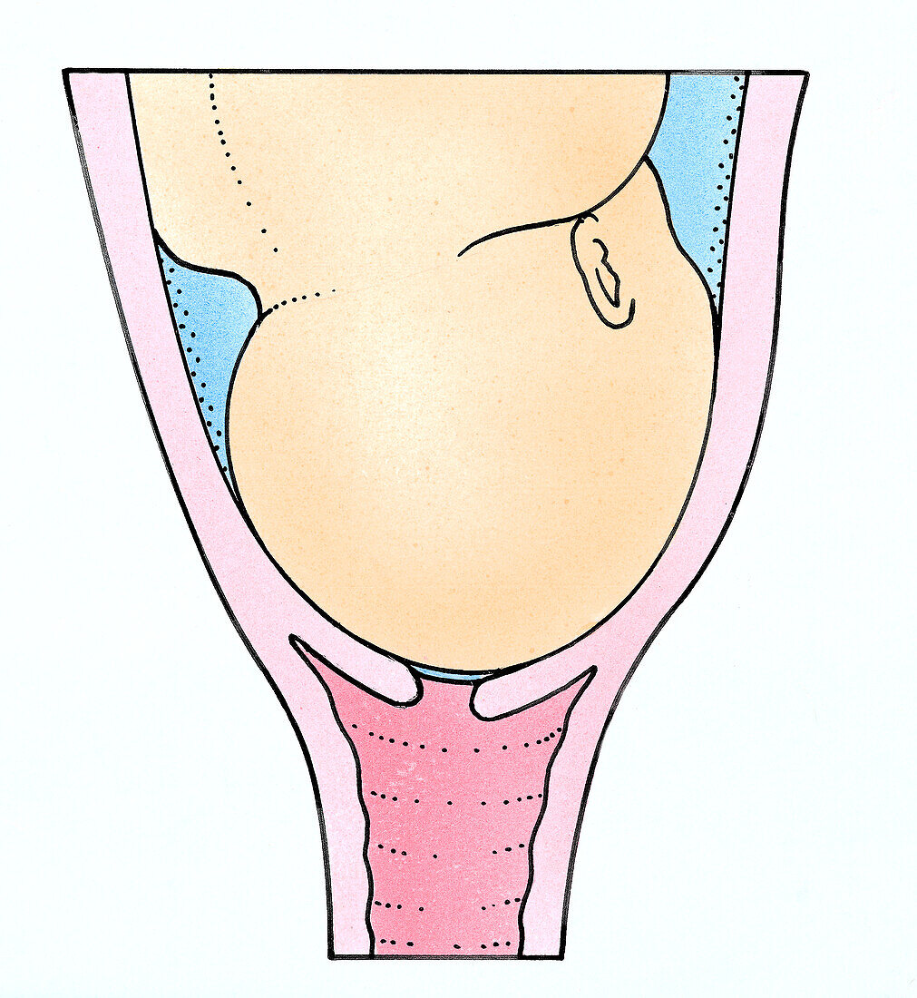 Head of baby resting on cervix, illustration