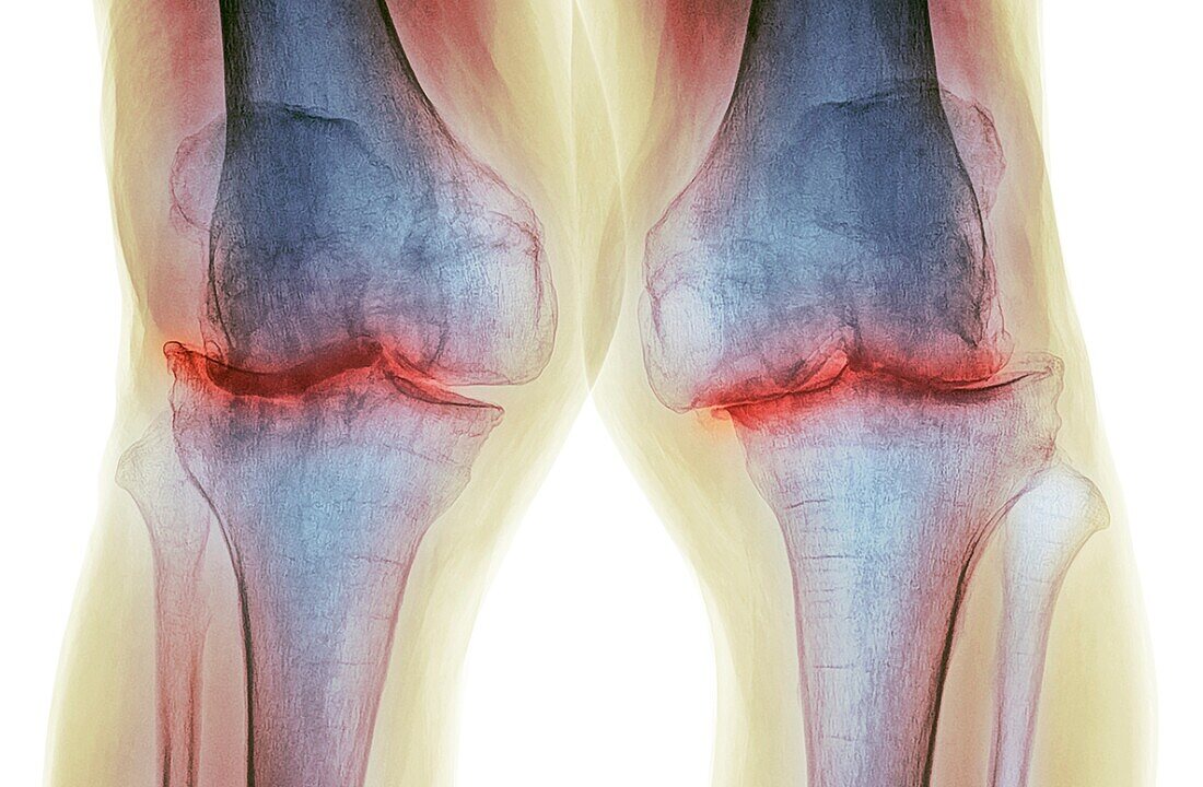 Knee osteoarthritis, X-ray