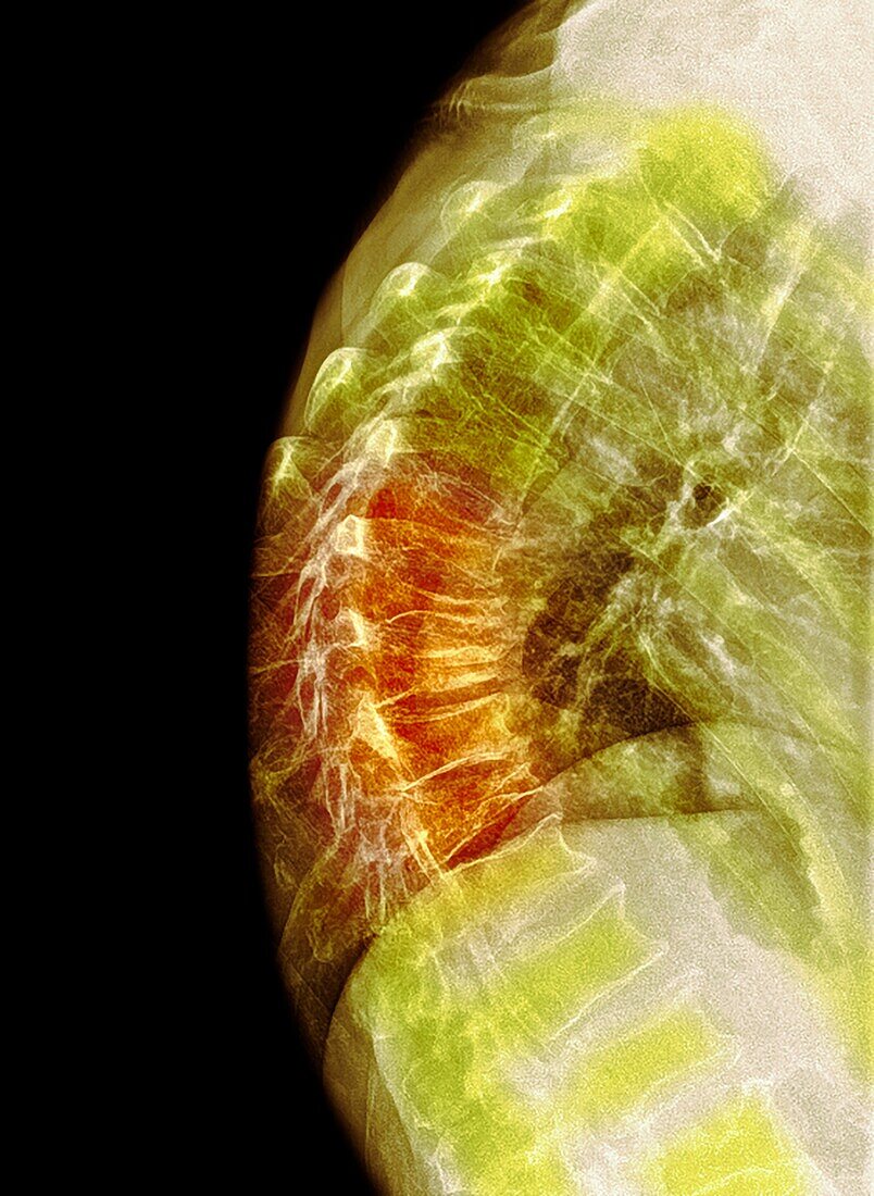 Spinal osteoporosis, X-ray