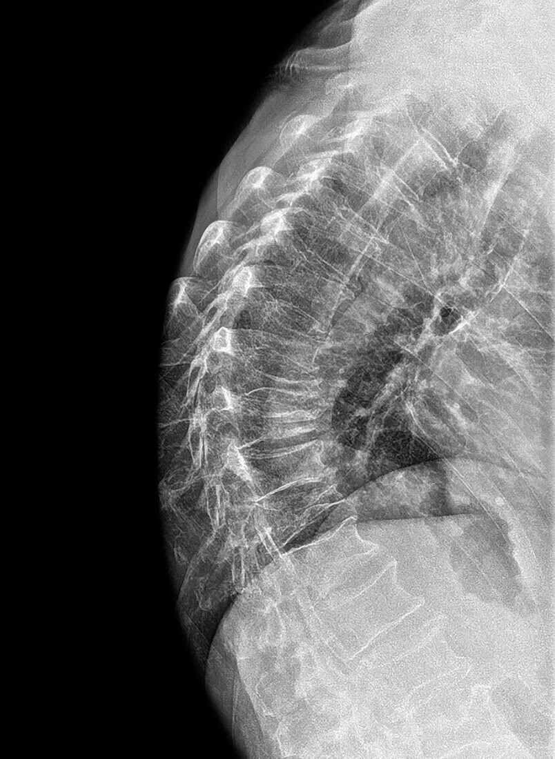 Spinal osteoporosis, X-ray