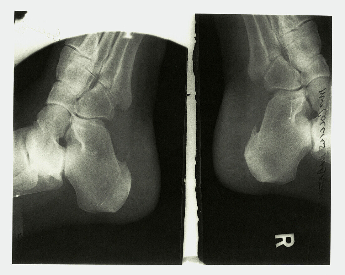 Heel of foot, X-ray