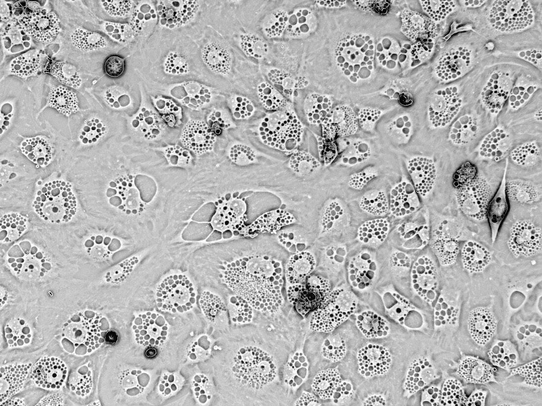 Fibroblasts with enlarged lysosomes, light micrograph