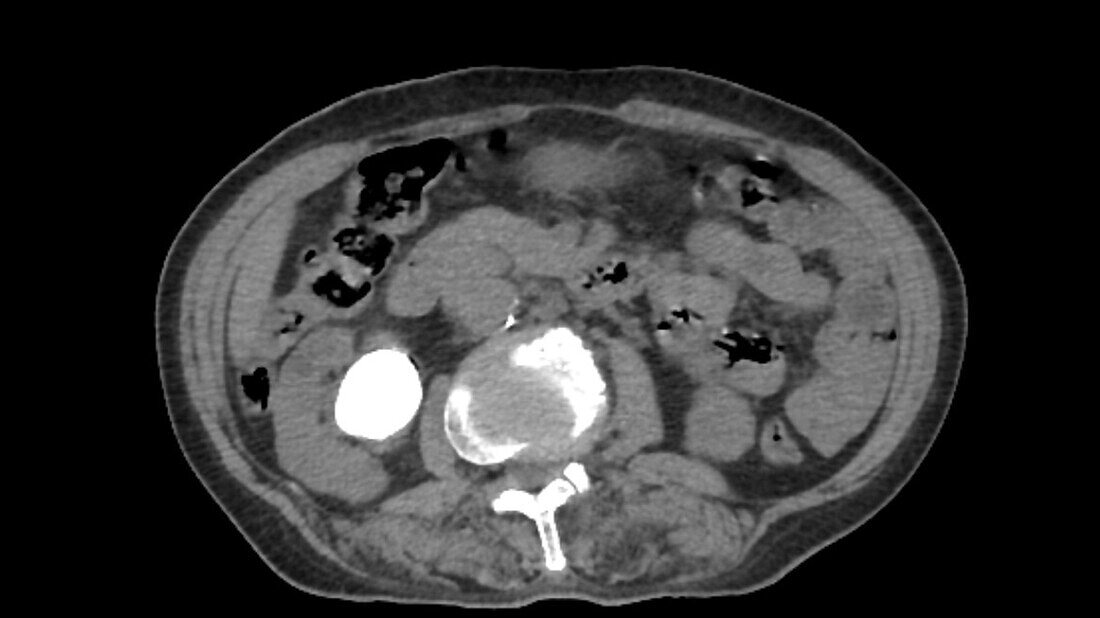Kidney stone, CT scan