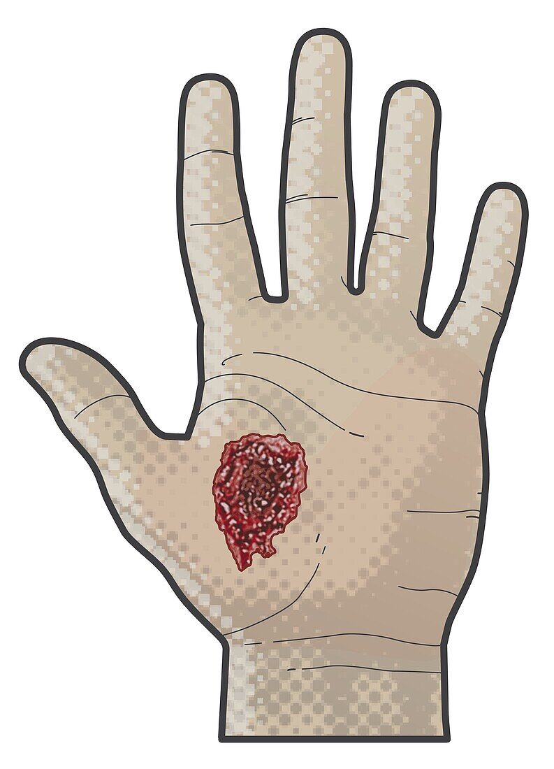 Bullet exit wound on palm of hand, illustration