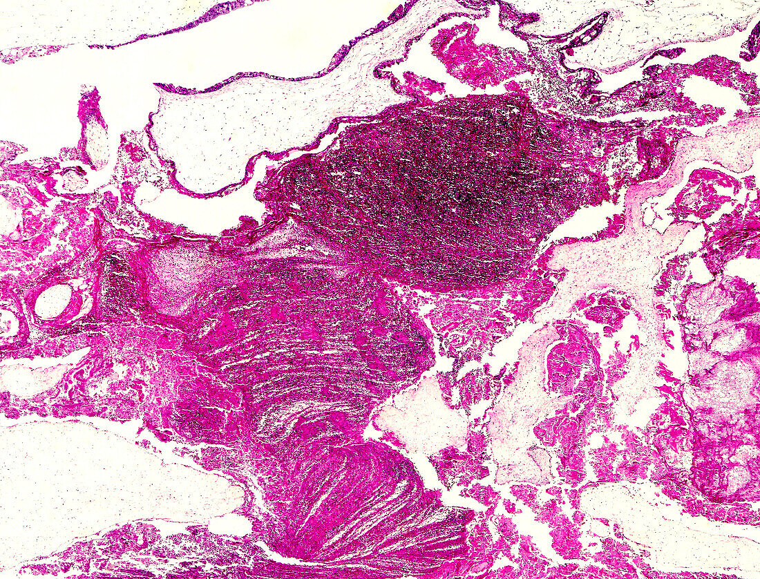 Gestational trophoblastic disease, light micrograph