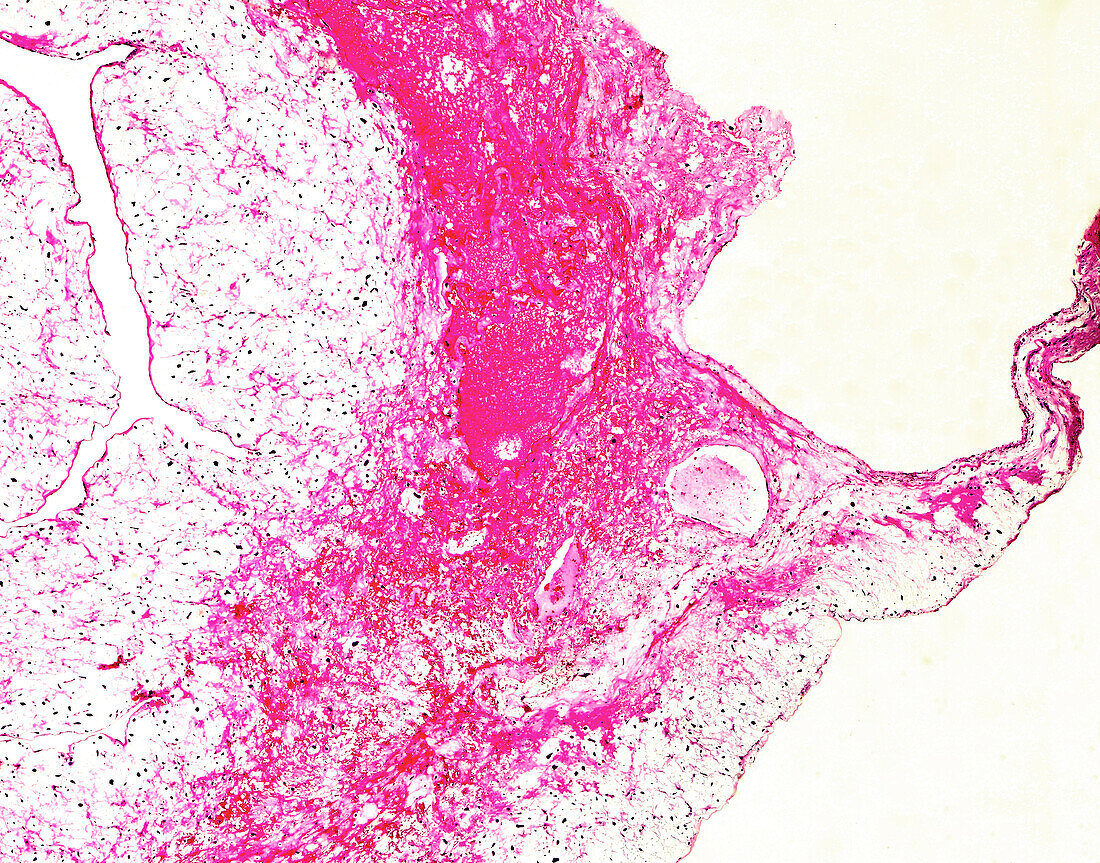 Cardiac sarcoma, light micrograph