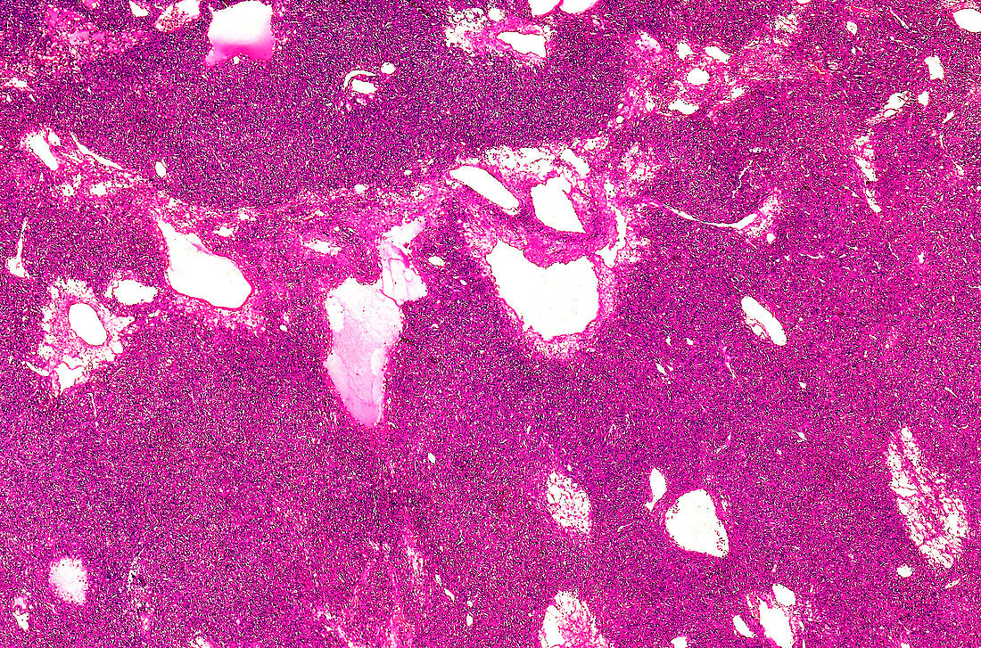 Pleural mesothelioma, light micrograph