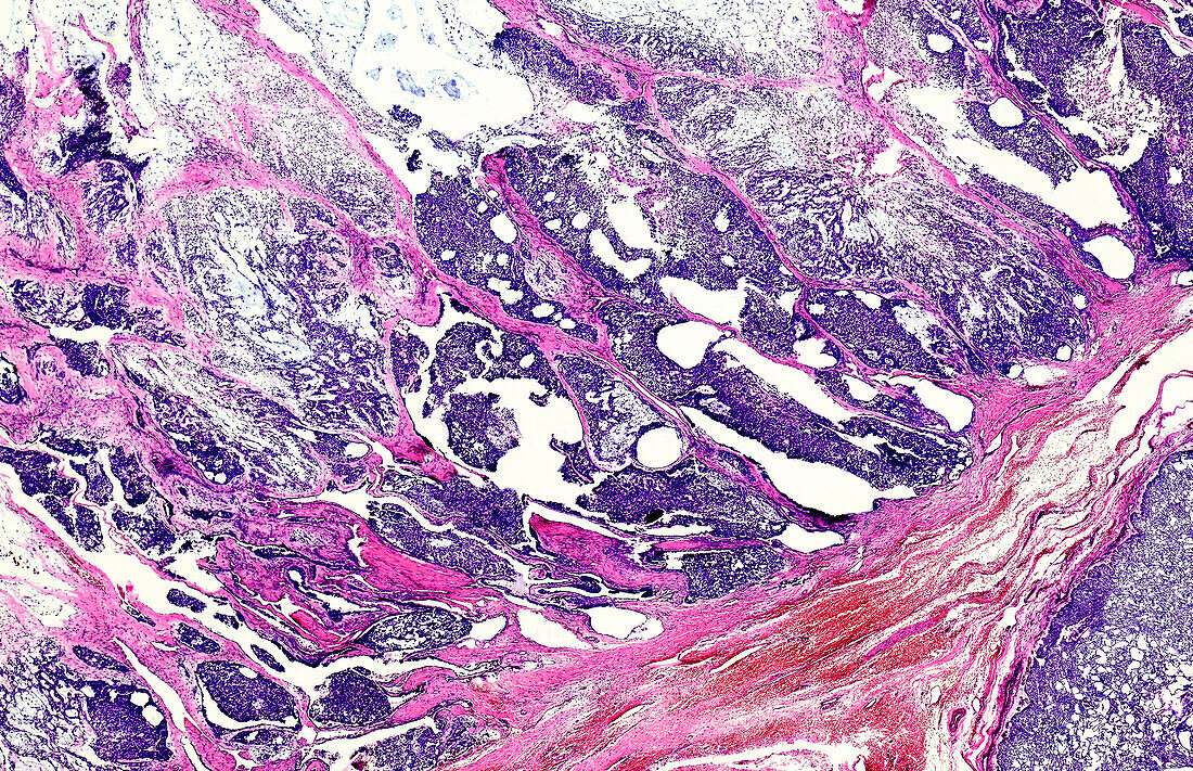 Salivary gland cancer, light micrograph