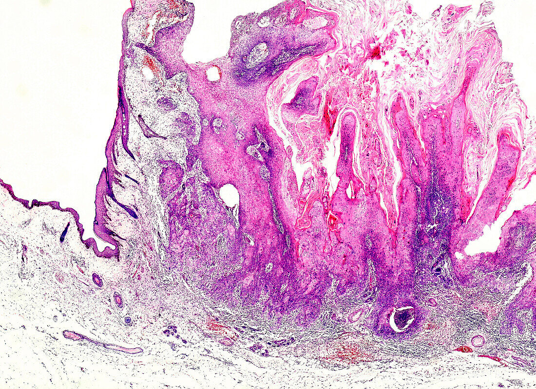 Vulval cancer, light micrograph