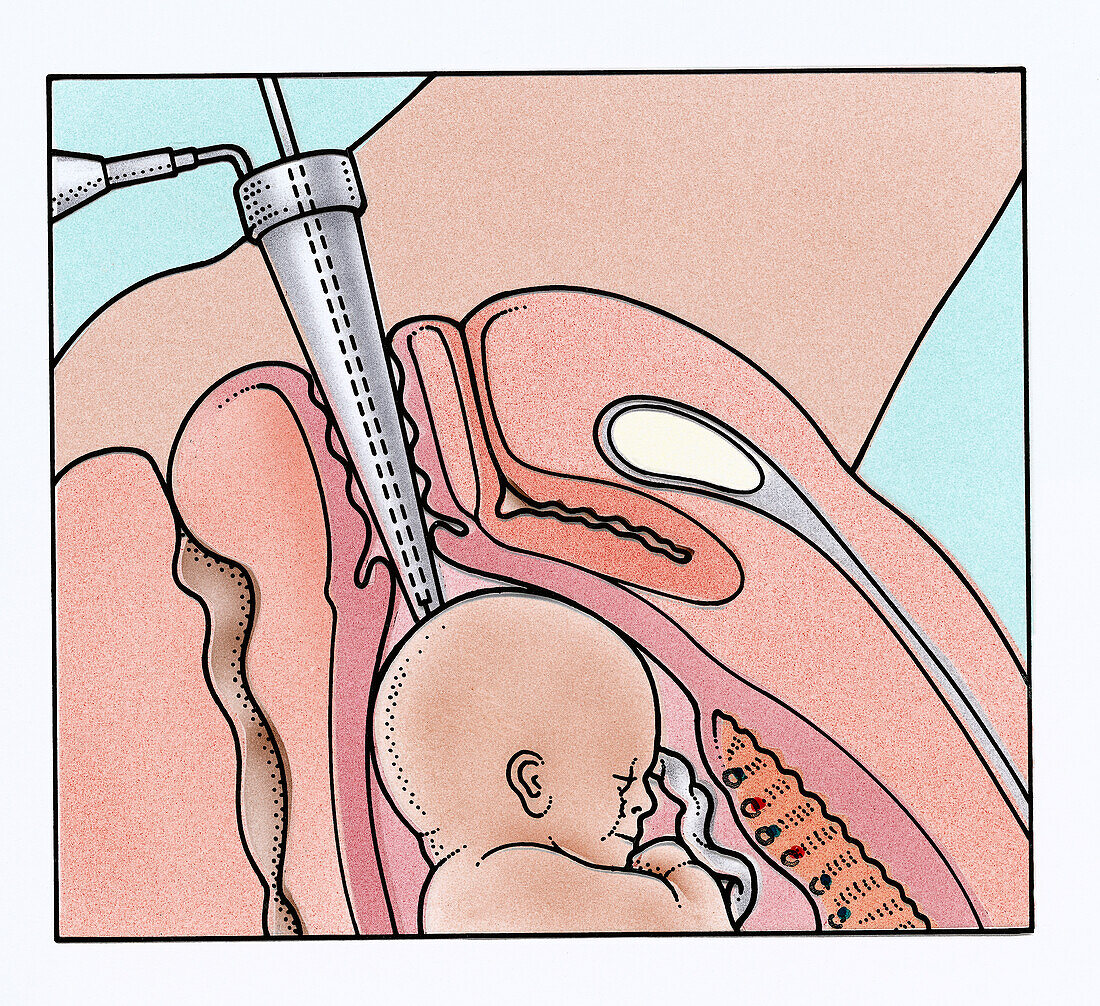 Instrument sampling blood from baby's scalp, illustration