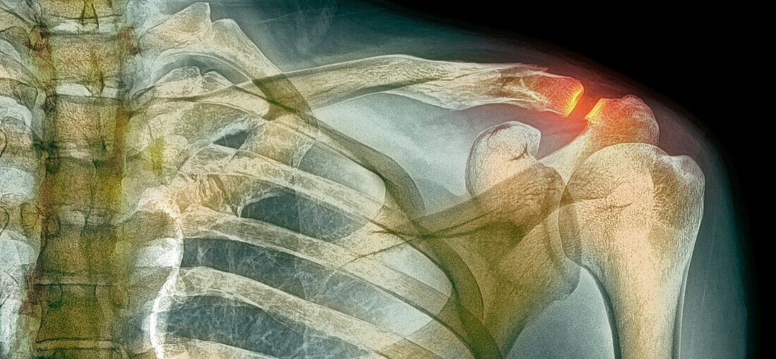 Fractured collar bone, X-ray