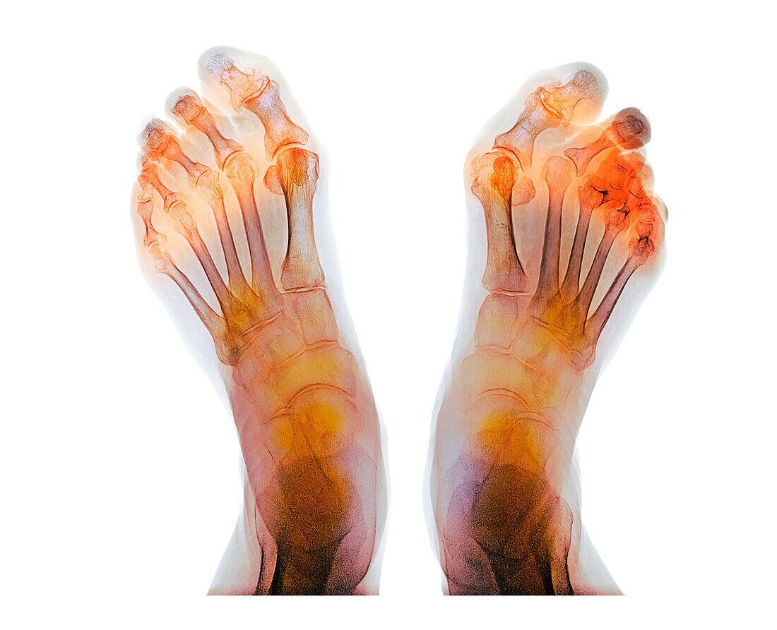 Rheumatoid arthritis, coloured X-ray