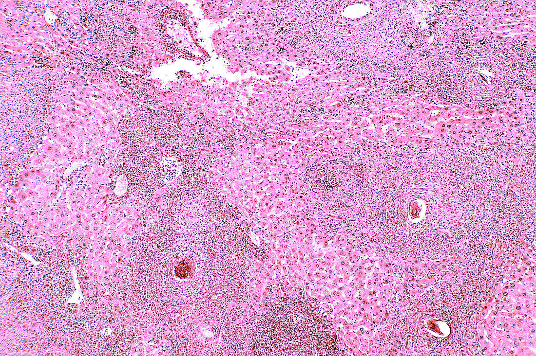 Light microscope Foreign body granuloma with hemosiderin and gia