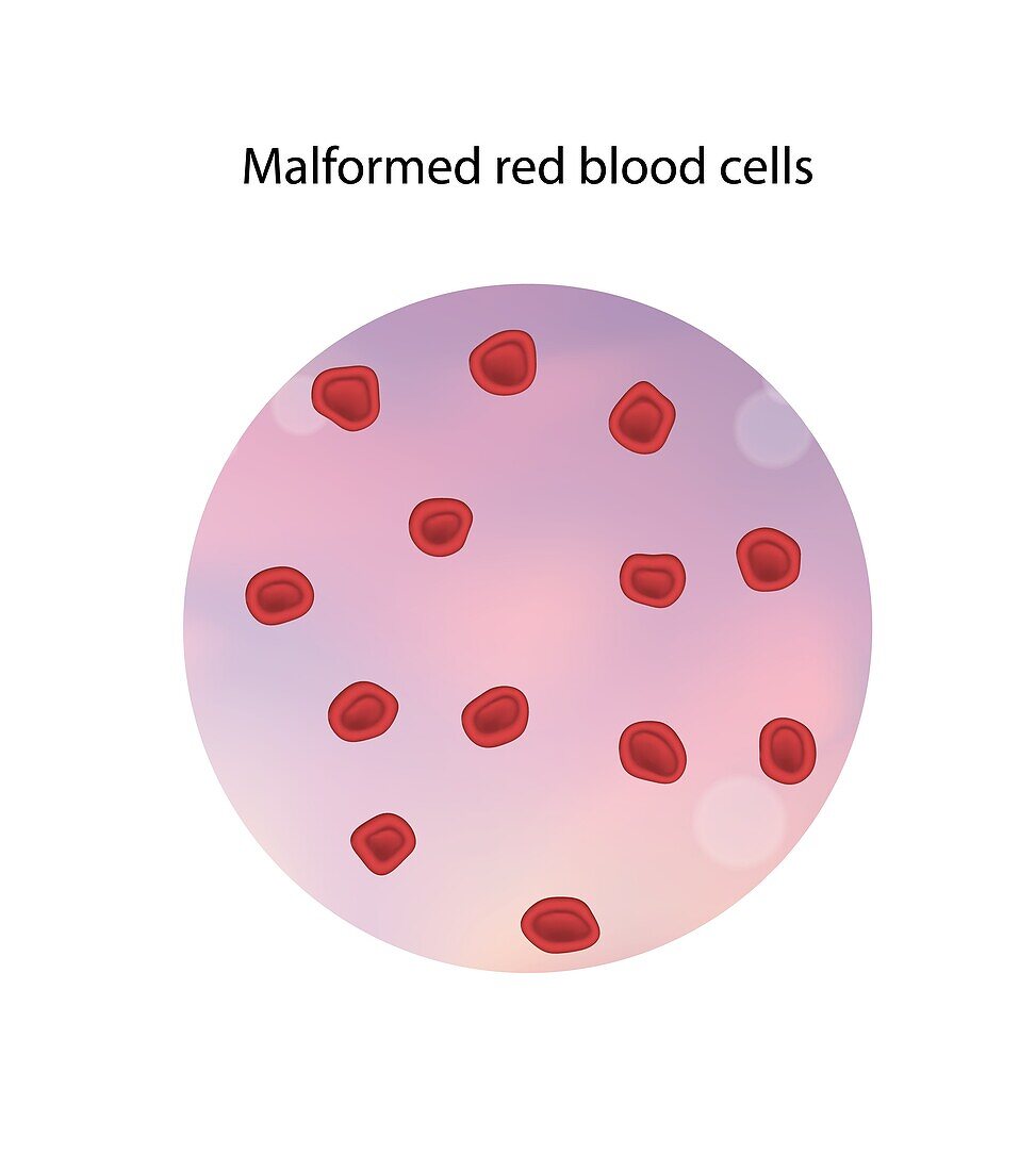 Malformed red blood cells, illustration
