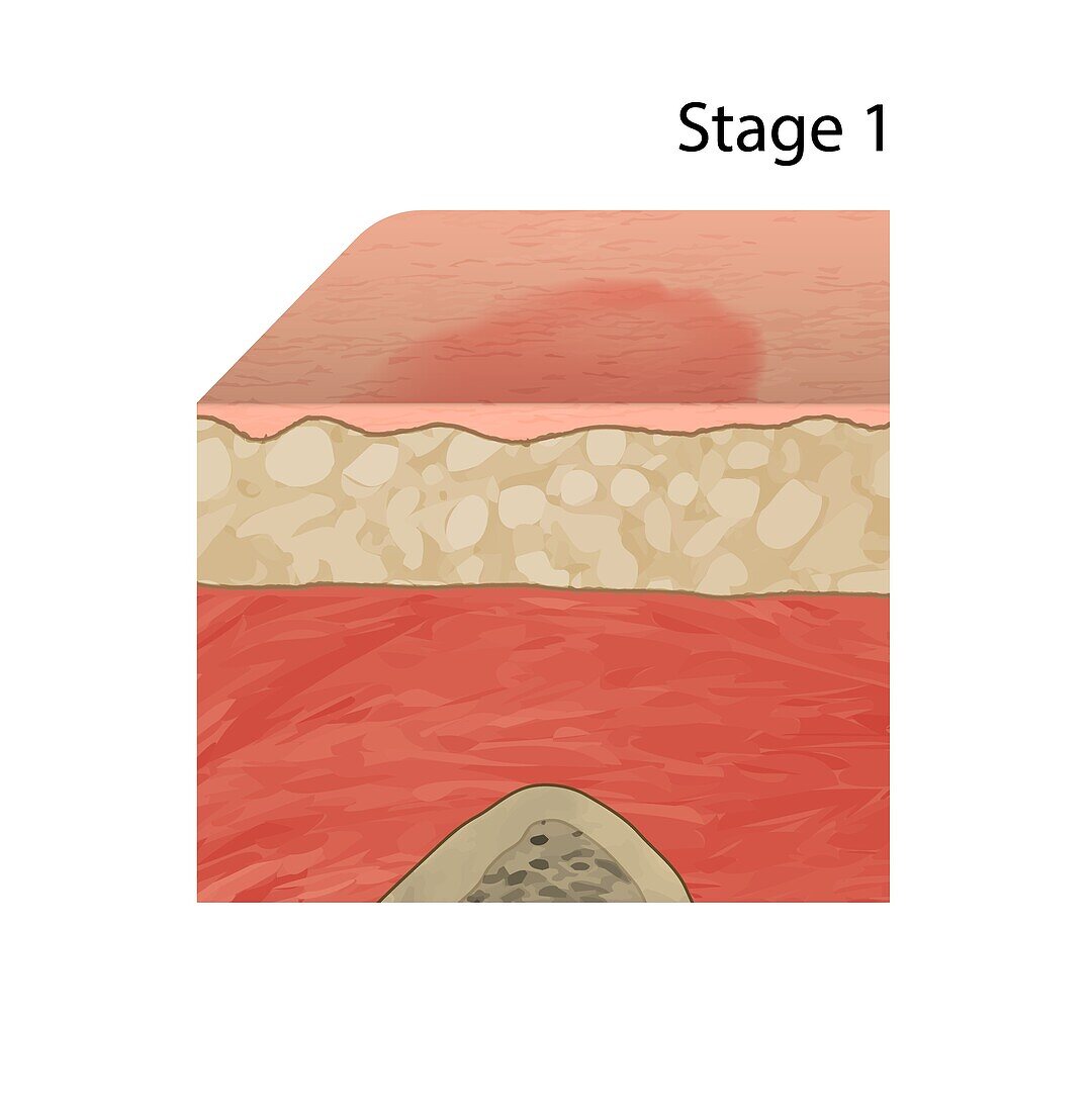Pressure sore stage 1, illustration