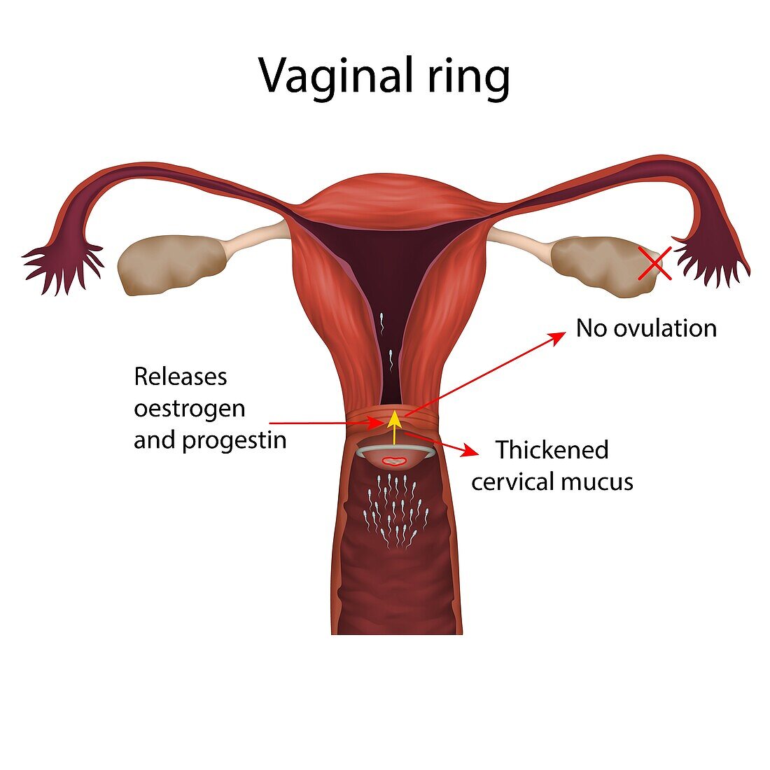 Vaginal ring, illustration