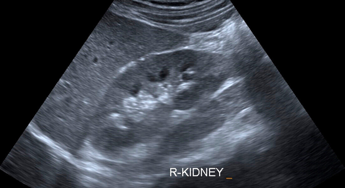 Healthy kidney, ultrasound scan
