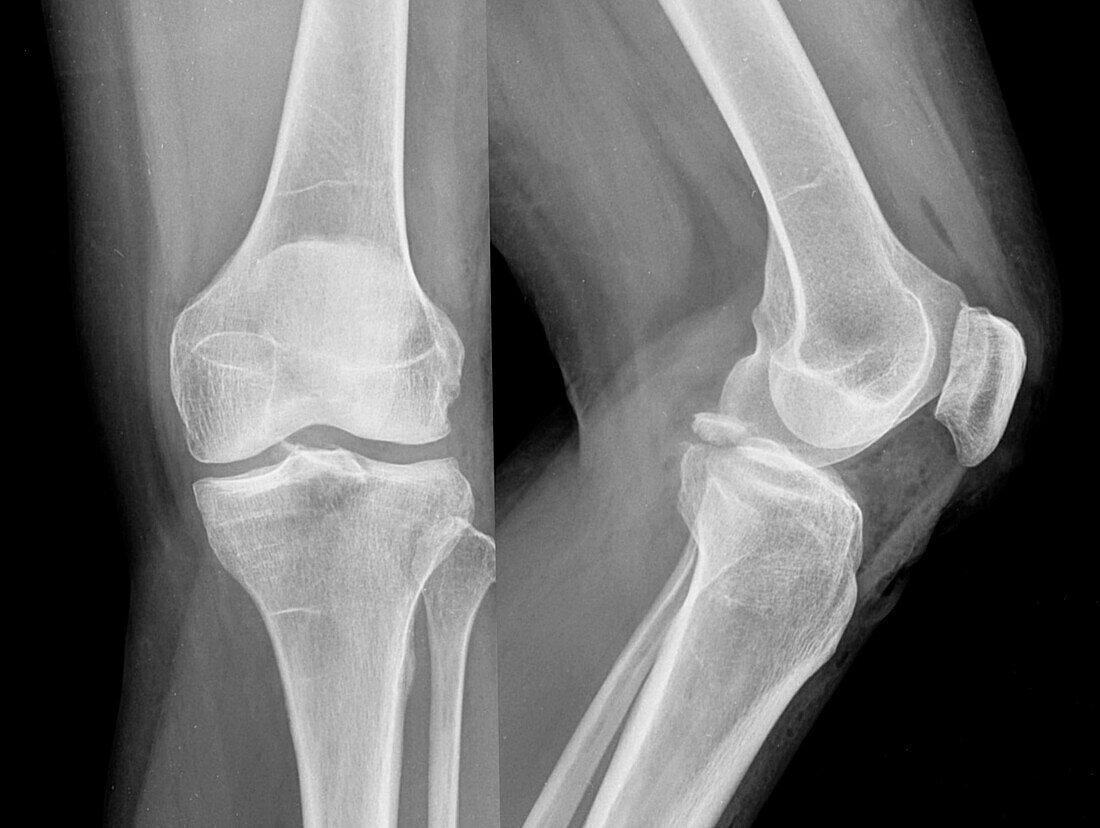 Posterior cruciate ligament avulsion fracture, X-ray