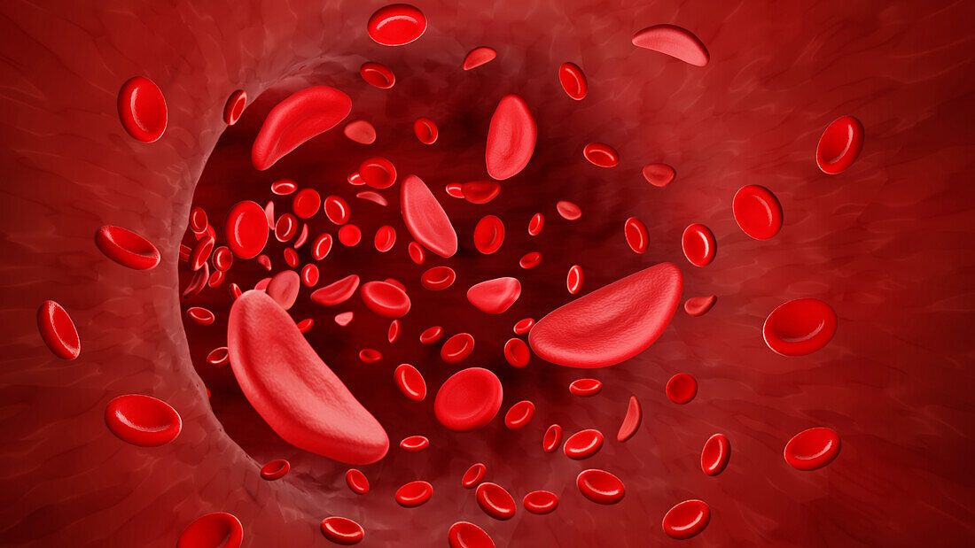 Sickle cell anaemia, illustration