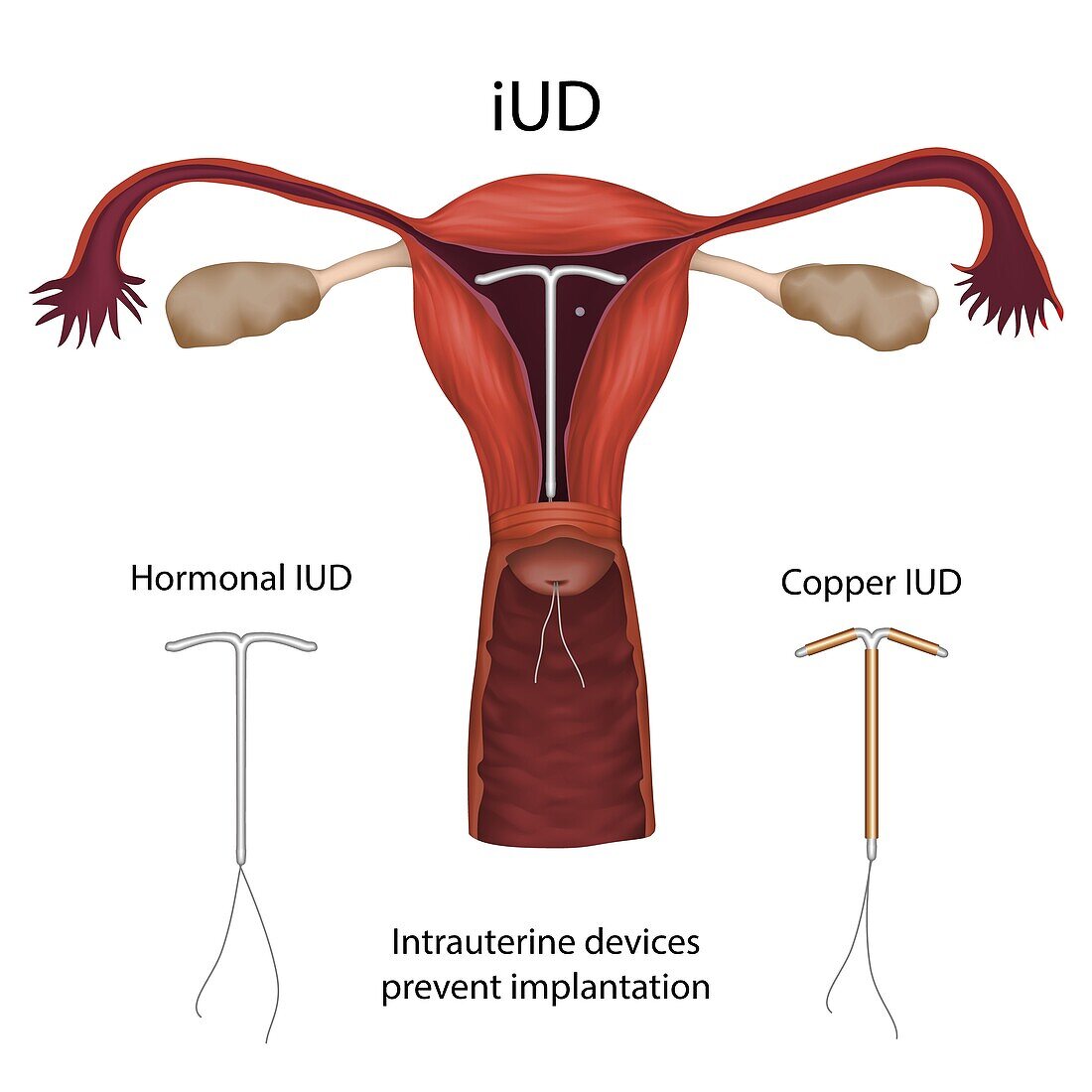 Intrauterine devices, illustration