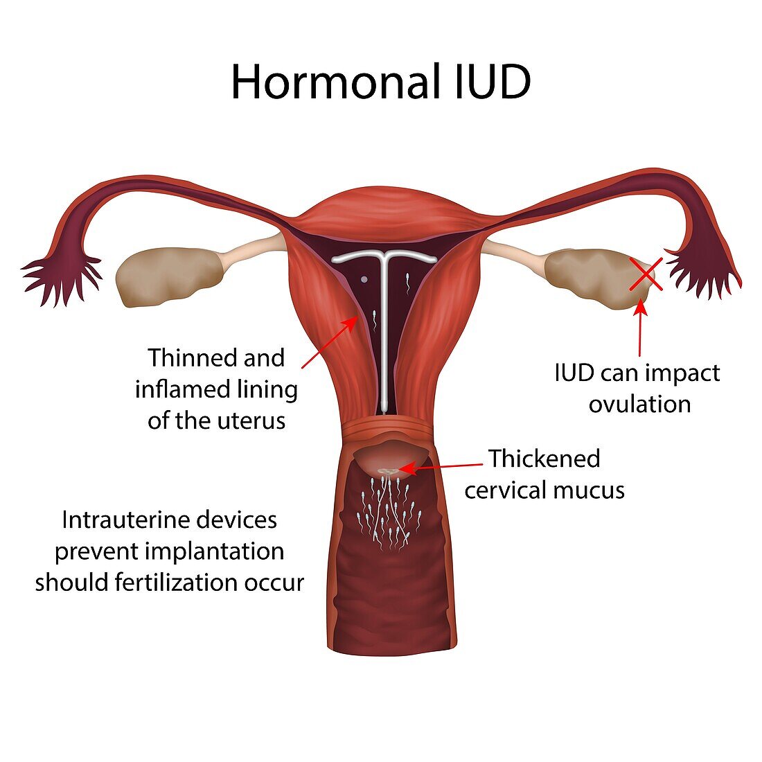 Hormonal IUD, illustration