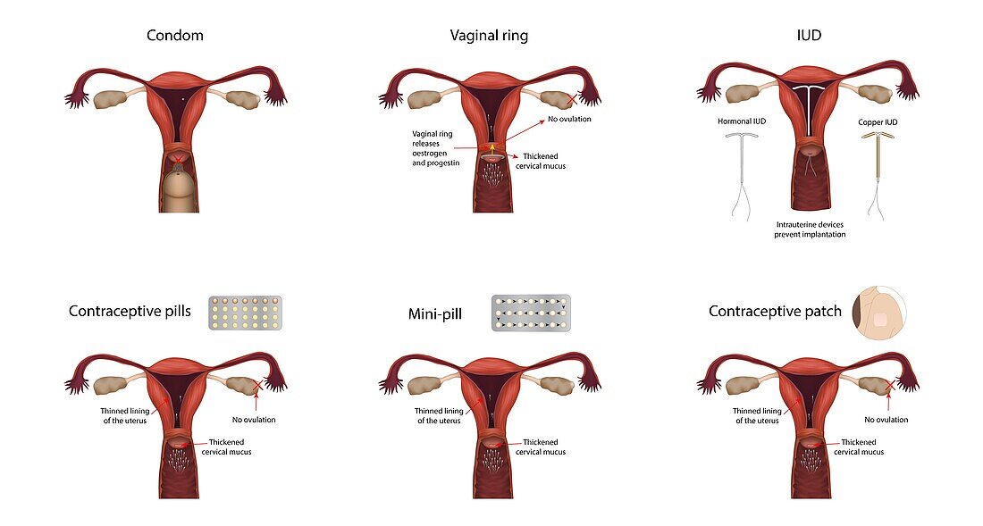 Contraception methods, illustration
