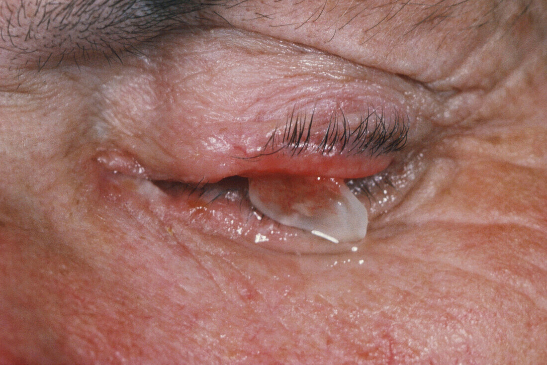 Glass fragment in eye