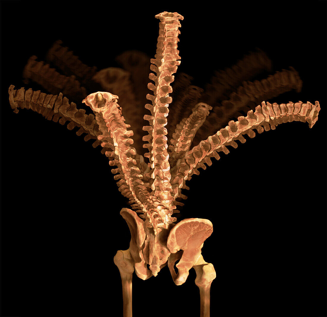 Spinal Column, Straightened and Bending