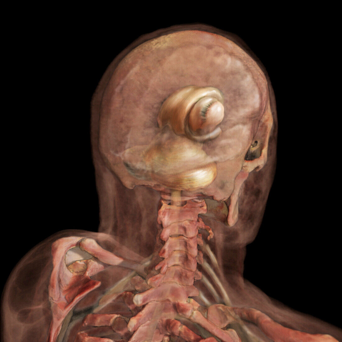 Caudate Nucleus and Lentiform Nucleus, Brain