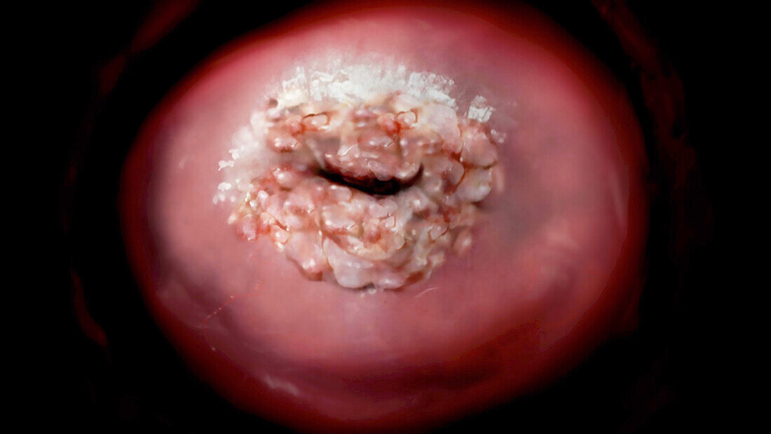 Cervix with Cancer, Speculum View