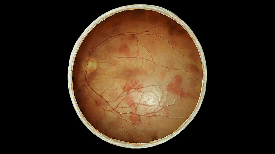 Macular Degeneration, Coronal Section of Eye