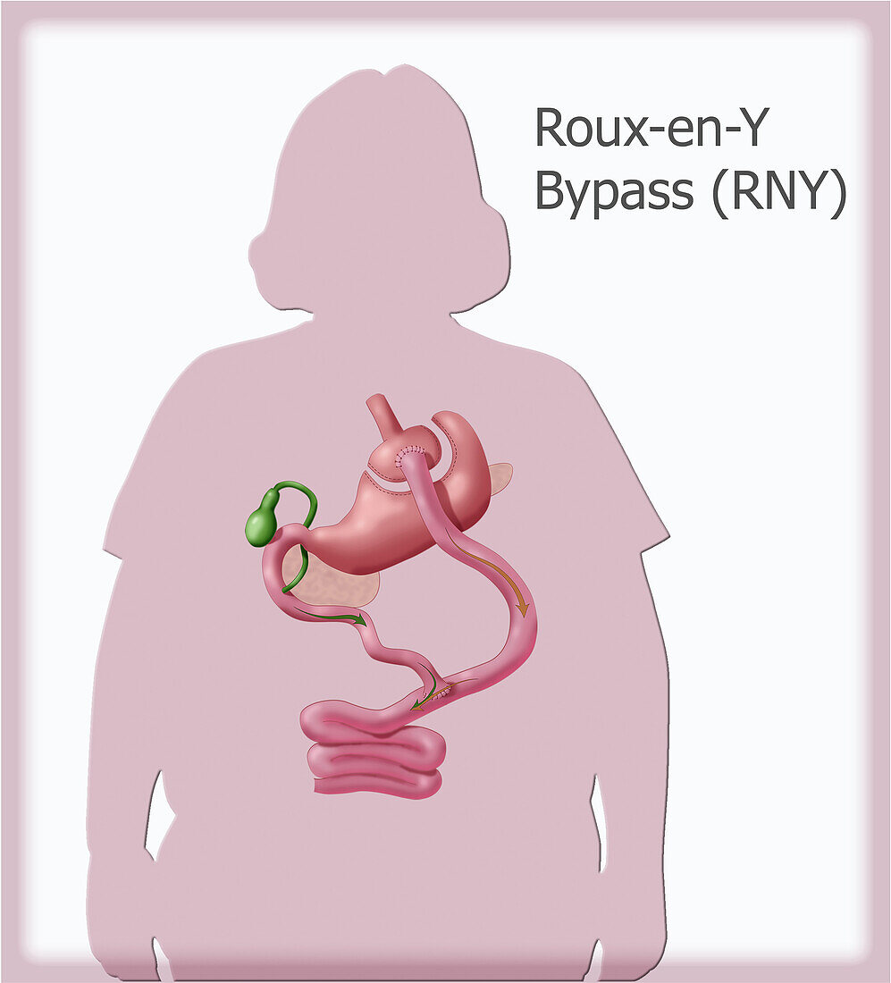 Roux-en-Y Gastric Bypass Surgery