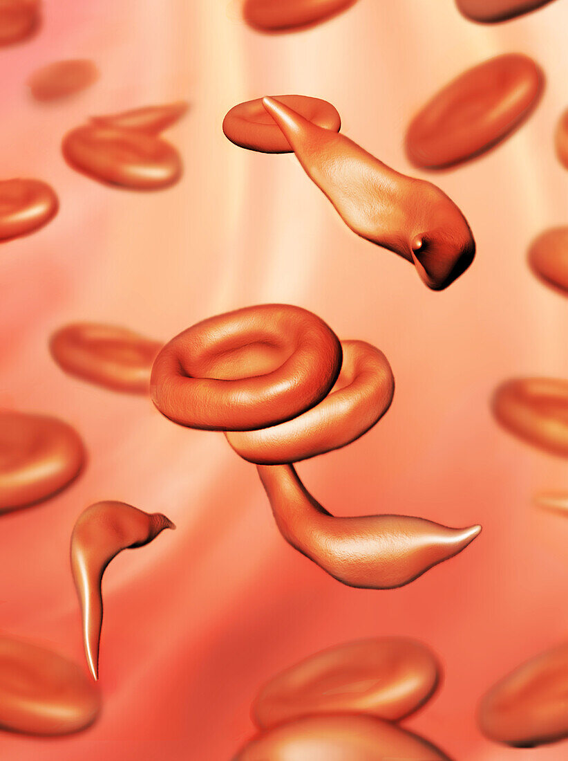 Sickle Cells, Illustration