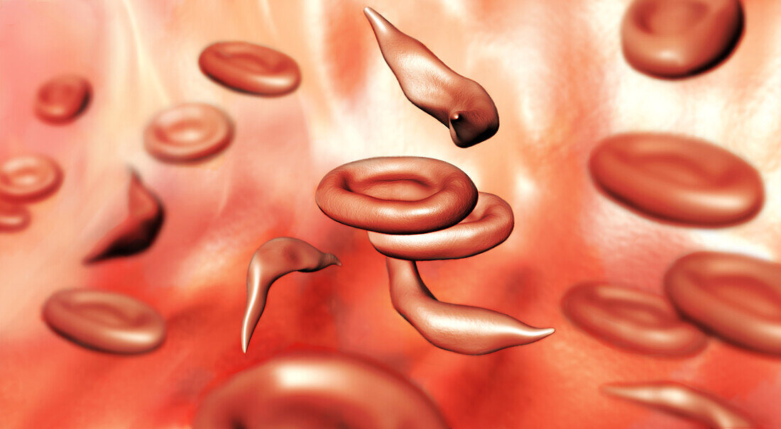 Sickle Cells, Illustration
