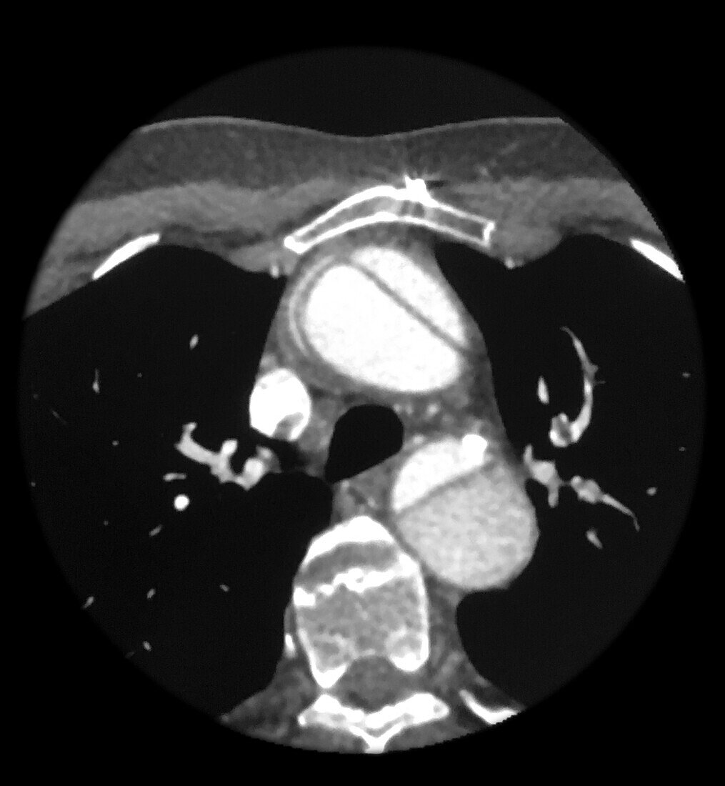 CTA Aortic Dissecting Aneurysm
