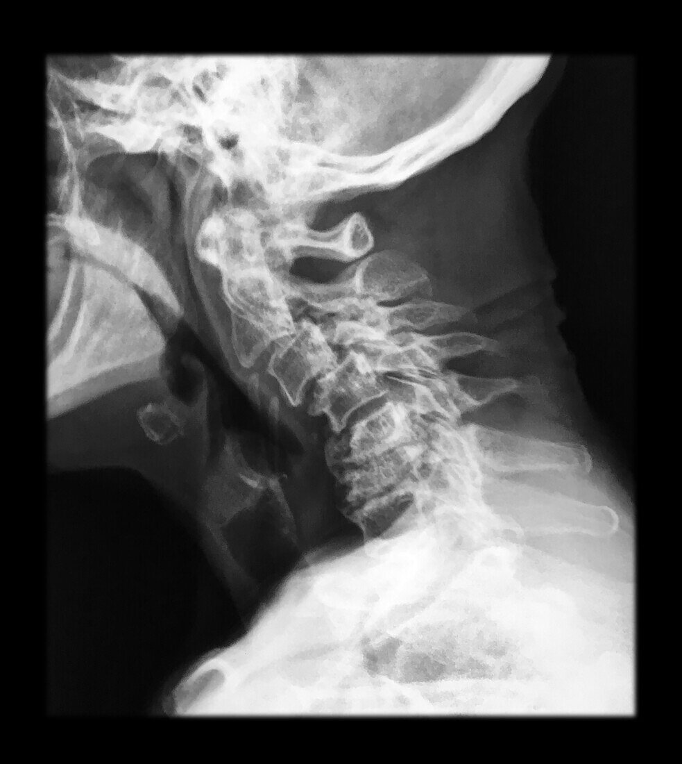 X-ray of Severe Degenerative Changes Cervical Spine