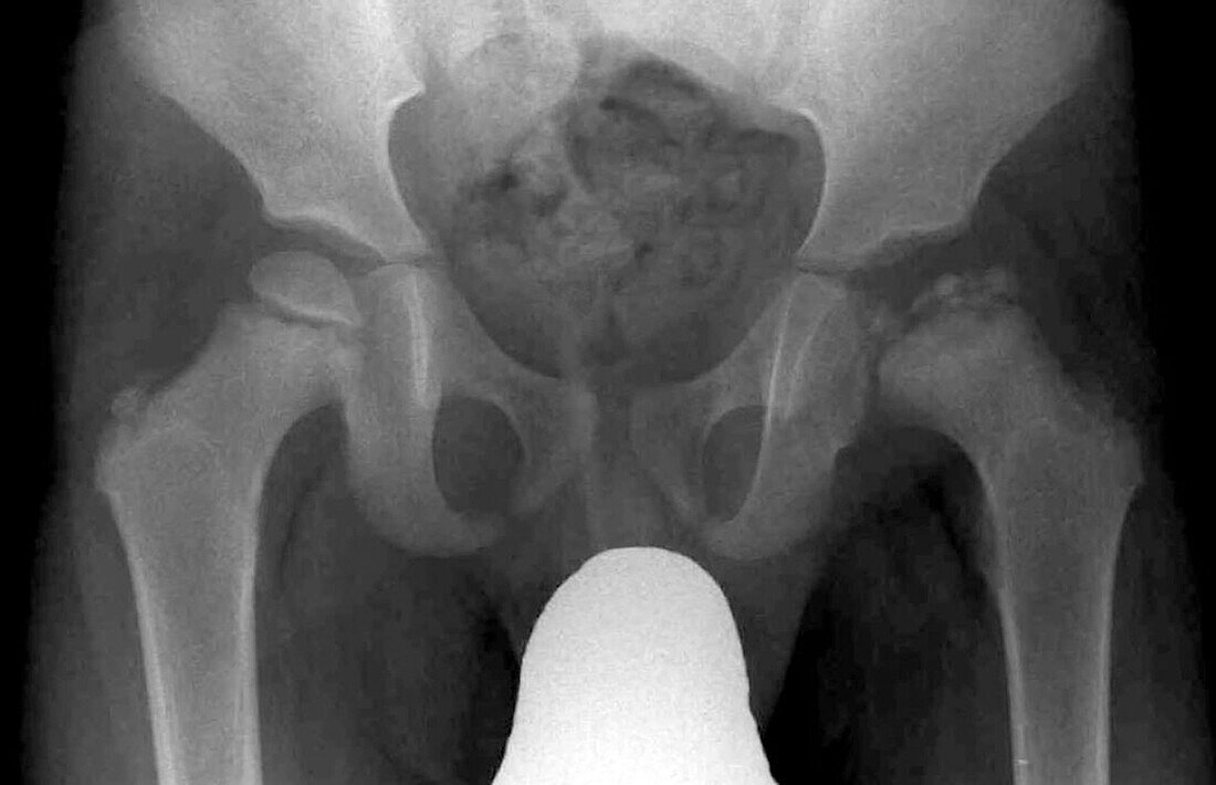 Perthes Disease, X-Ray