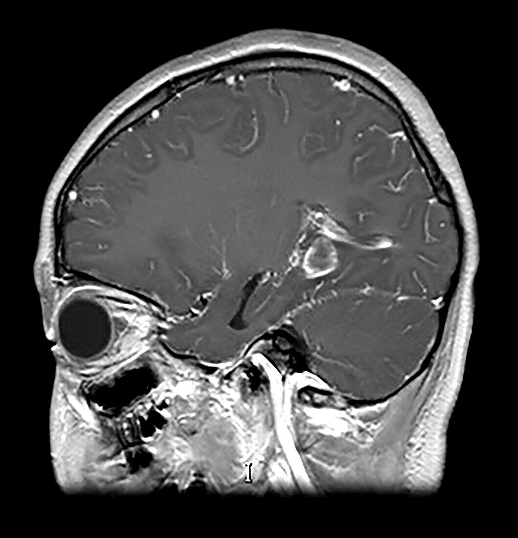 Temporal Lobe AVM with Haemorrhage in Child