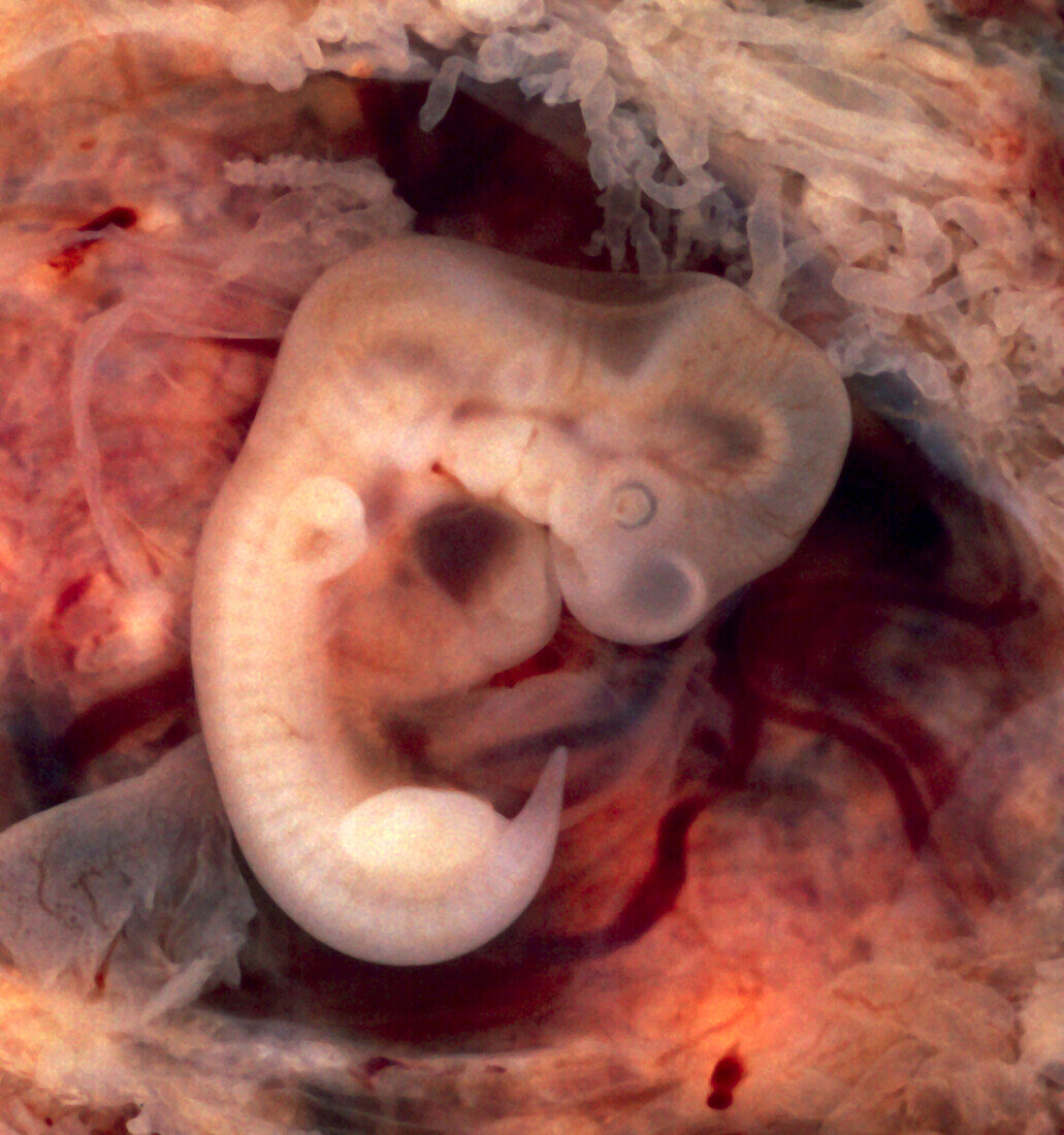 Ectopic Embryo