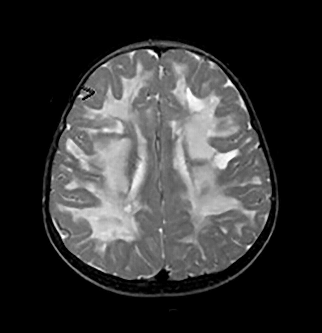 Vanishing White Matter Disease